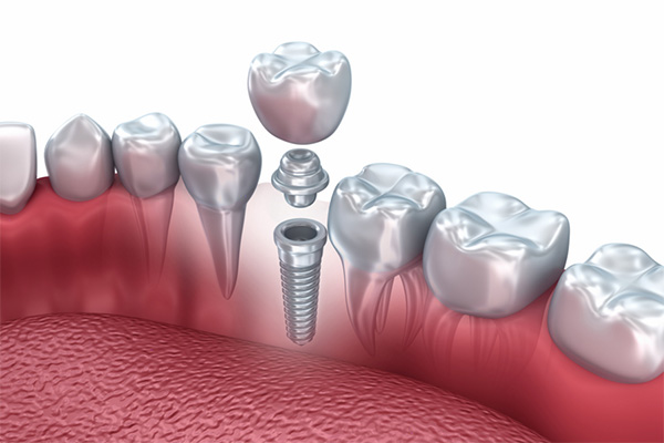 diş implantları