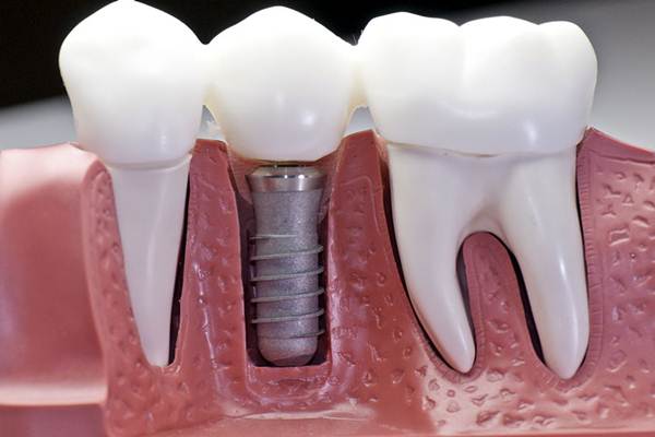 implant tedavisi